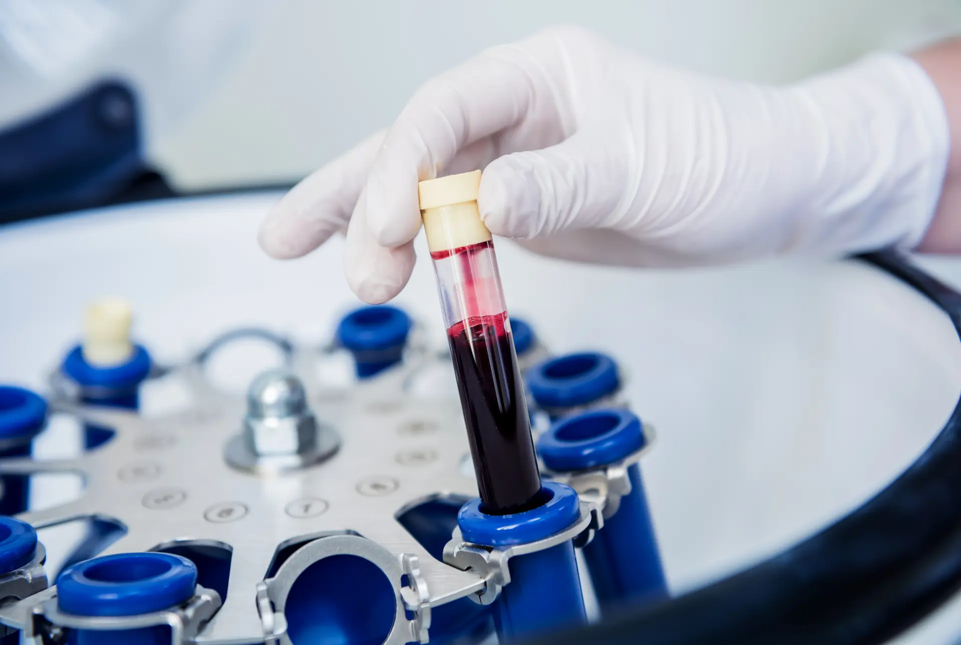 Mano con guanto medico inserisce una provetta di sangue in una centrifuga da laboratorio per la preparazione del plasma ricco di piastrine (PRP) nel centro