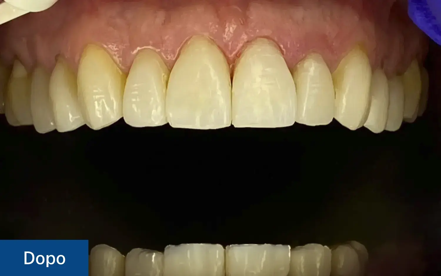 Risultato finale (Dopo) del trattamento con faccette dentali: restauro estetico completo con denti bianchi, naturali e perfettamente allineati