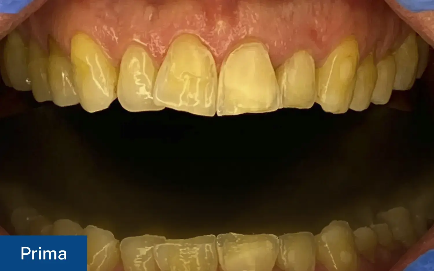 Situazione iniziale (Prima) di un caso clinico con denti abrasi, ingialliti e con smalto irregolare prima del trattamento con faccette dentali