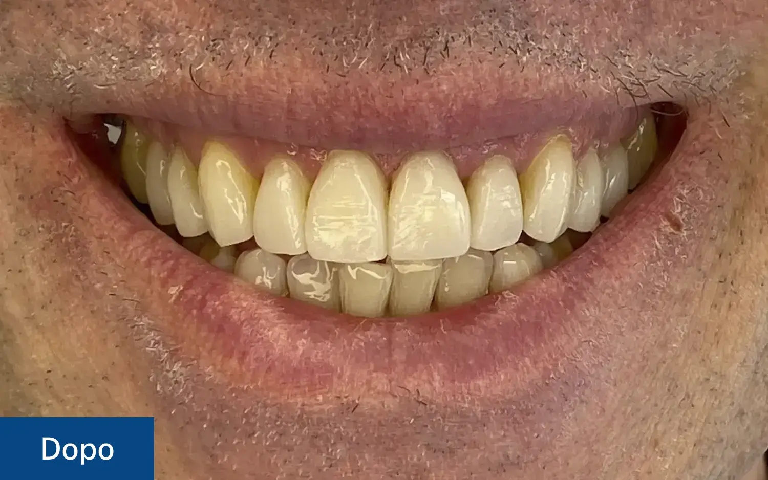 Risultato finale (Dopo) della correzione della forma dei denti: sorriso armonioso, bianco e simmetrico grazie all'applicazione di faccette dentali