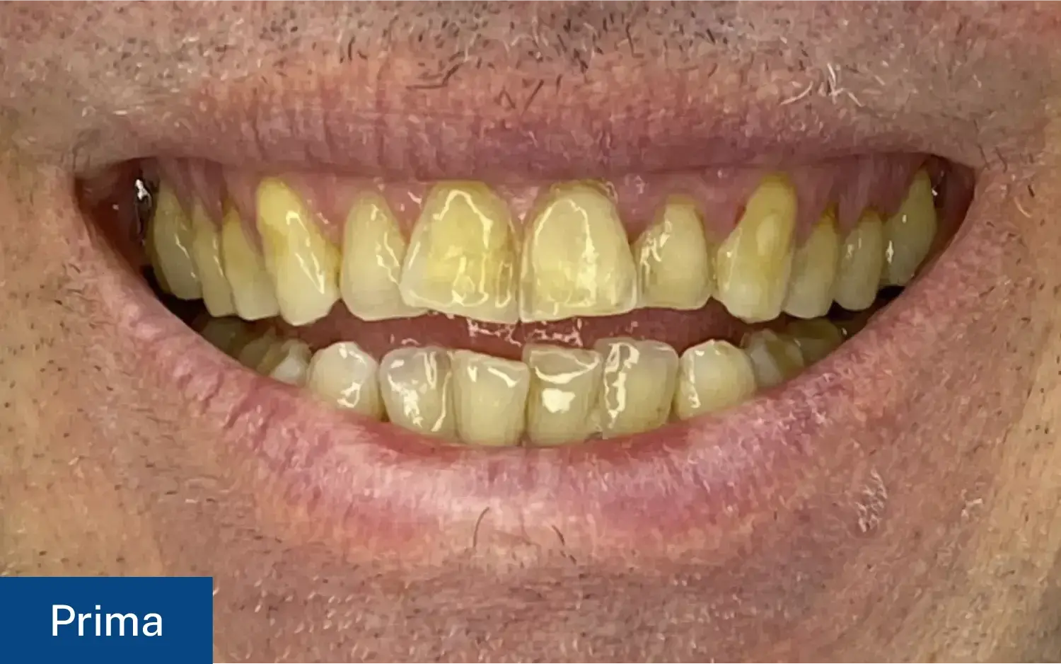 Situazione iniziale (Prima) di un paziente con smalto usurato e discromie evidenti, prima della correzione della forma dei denti con faccette